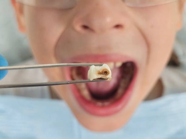 Best Urgent Care for Lost Fillings or Crowns in Bainbridge, GA